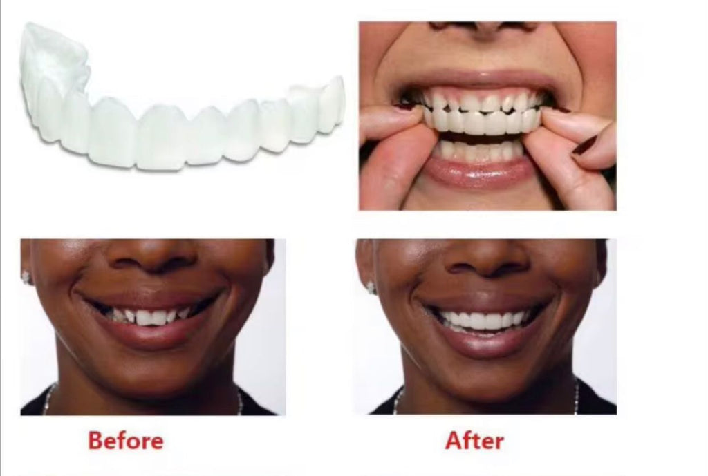 Snap-On Smile – Prothèse dentaire esthétique instantanée