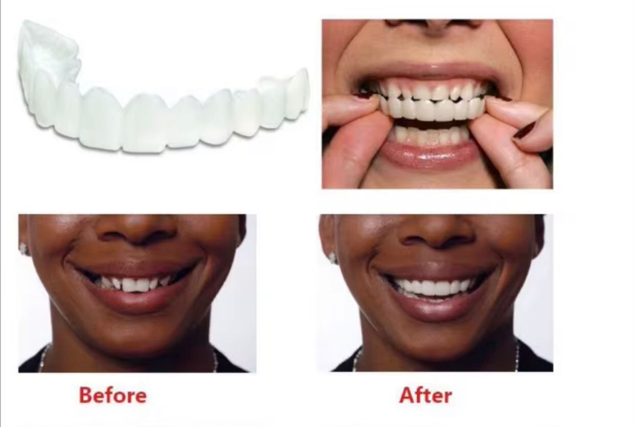 Snap-On Smile – Prothèse dentaire esthétique instantanée