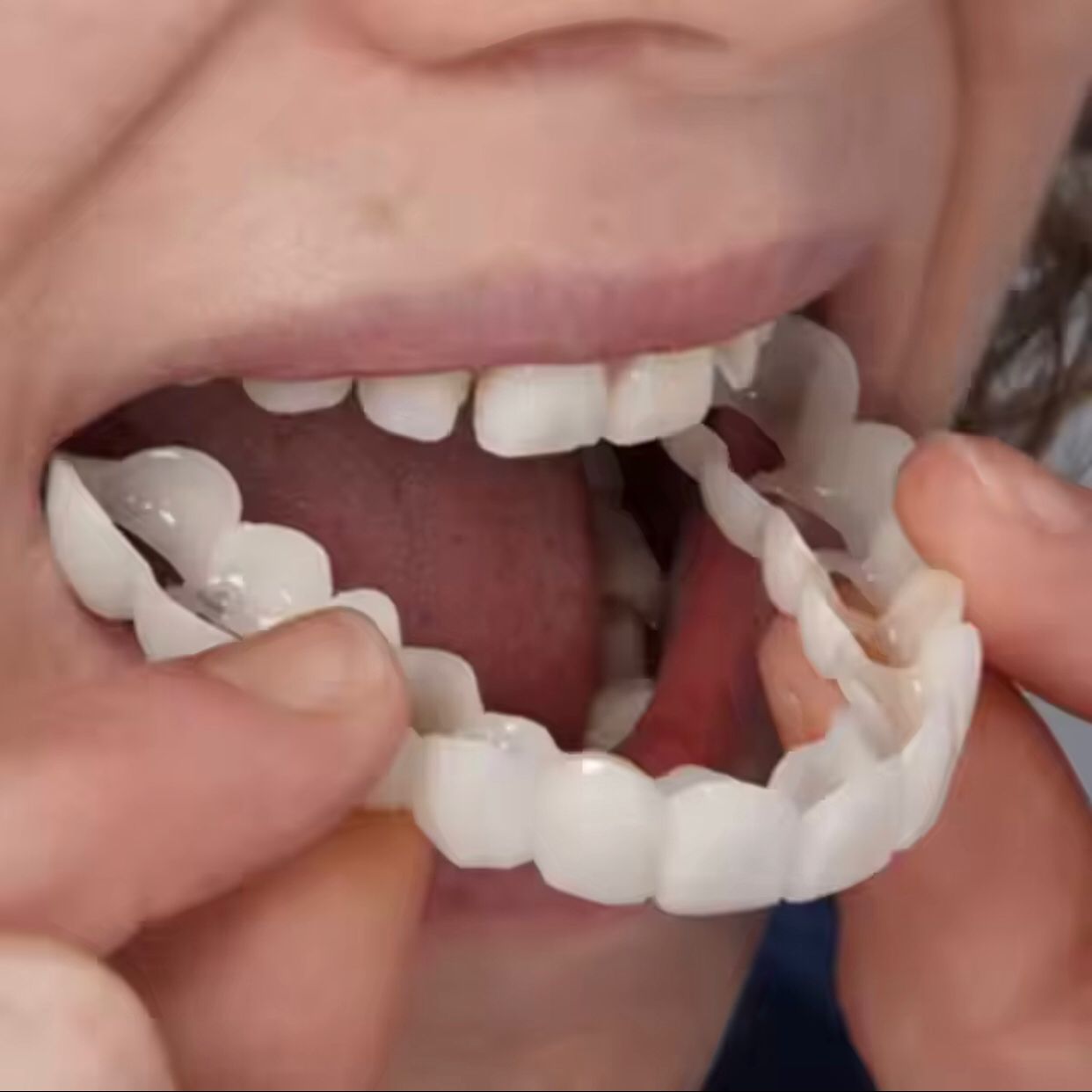 Snap-On Smile – Prothèse dentaire esthétique instantanée